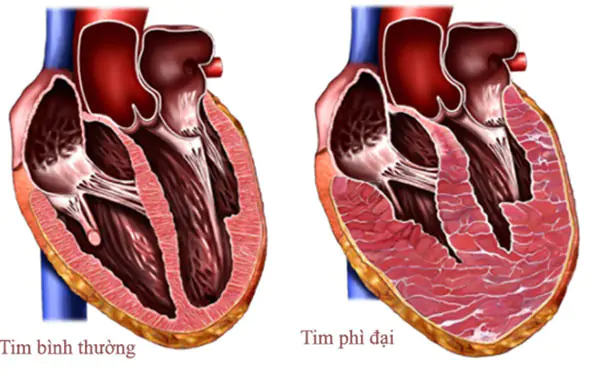 Bị phì đại cơ tim, bệnh van tim có nguy hiểm không?